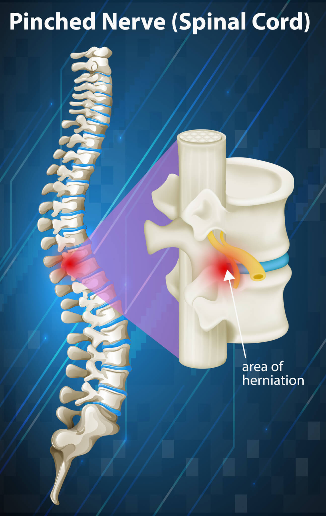 A medical diagram shows the area of herniation on a spine