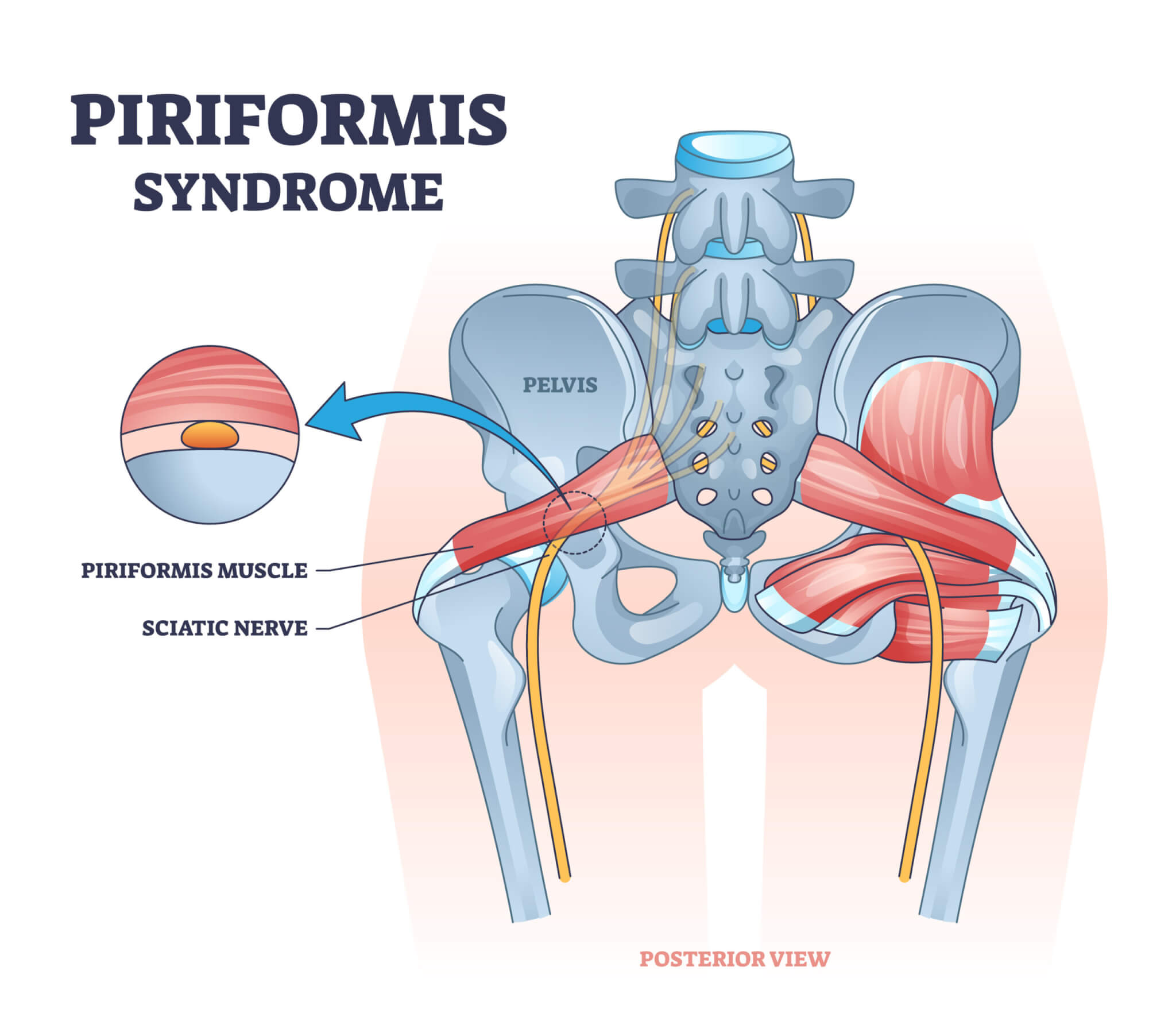 Medical diagram: Piriformis Syndrome is caused when Sciatic nerve compression between the Piriformis muscle and bone causes pain